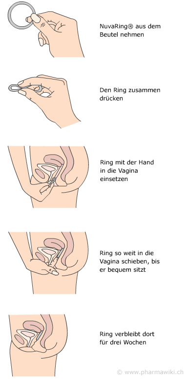 Nuvaring Gewichtszunahme Nuvaring Gewichtszunahme