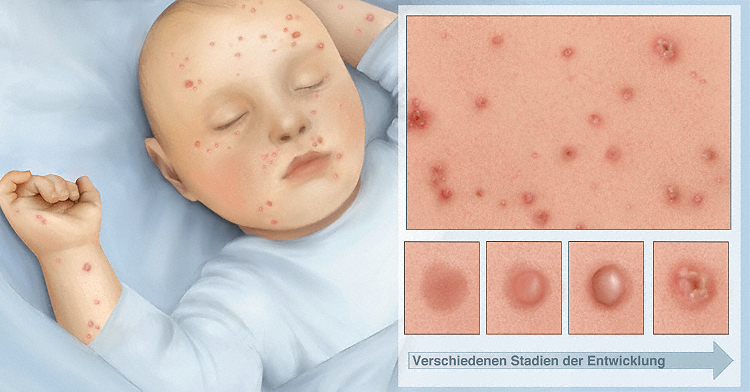 Pictures Of Chickenpox On Adults