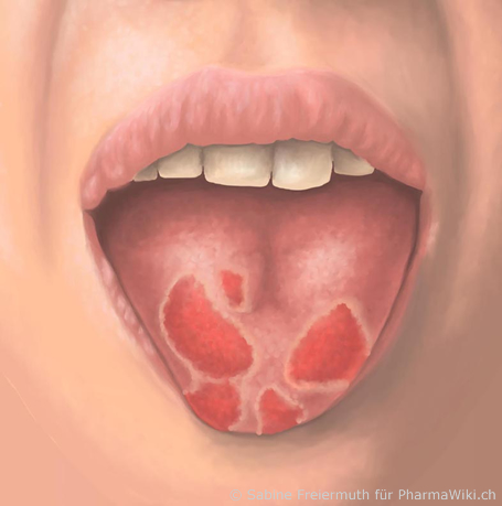 pinker fleck auf zunge welcher nicht von belag betroffen ist zahnarzt mund ...